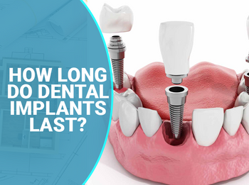 How Long do Dental Implants Last?